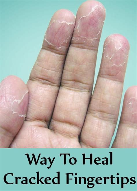 How To Heal Cracked Fingertips Remedies For Cracked Fingertips