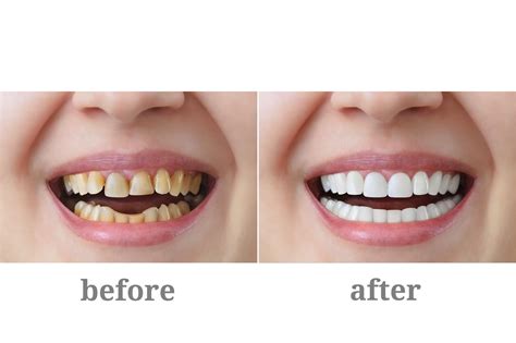 Porcelain Crowns And Porcelain Bonded Crowns Treatment Care And Advice