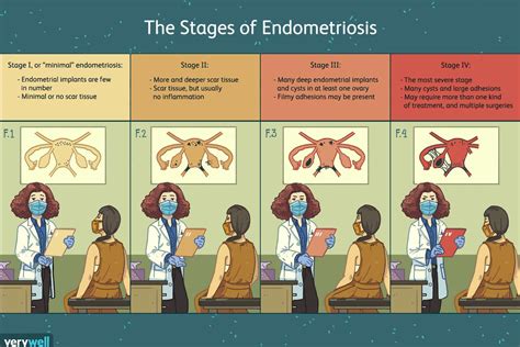 Endometriosis Stages Endometriosis Stages And How They Are Measured