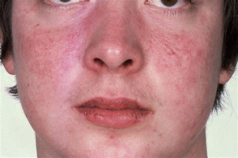 Itchy Face Facial Rash Causes Pictures Treatment Remedies
