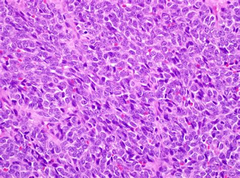 Pathology Outlines Synovial Sarcoma