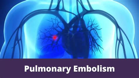 Pulmonary Embolism Mthfr Support Australia