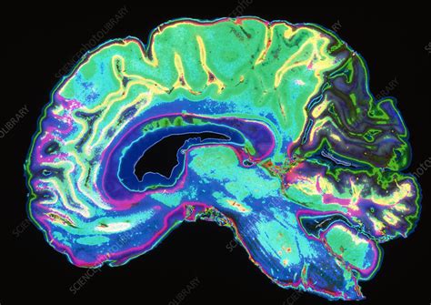 Coloured Sagittal Slice Through A Healthy Brain Stock Image P330