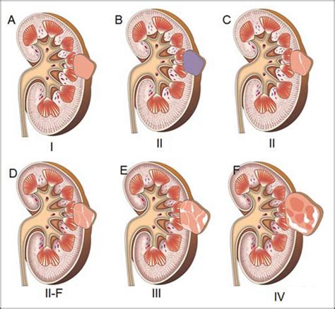 Kidney Cyst Causes Diagnosis Symptoms Complications And Treatment
