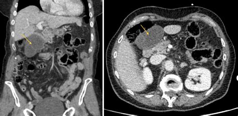 Cureus Incidental Finding Of Gallbladder Torsion During Laparoscopic