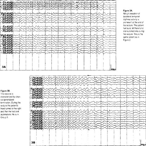 Figure 38 From Ictal Scalp Eeg Findings In Patients With Mesial
