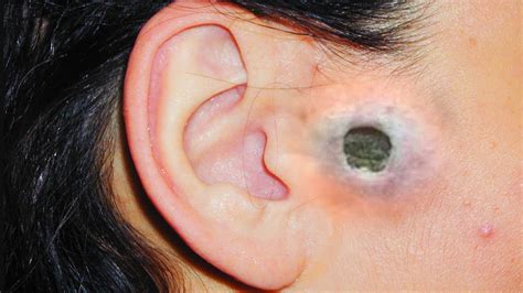 Ear And Nose Blackheads Biggest And Most Popular Comedone Extractions