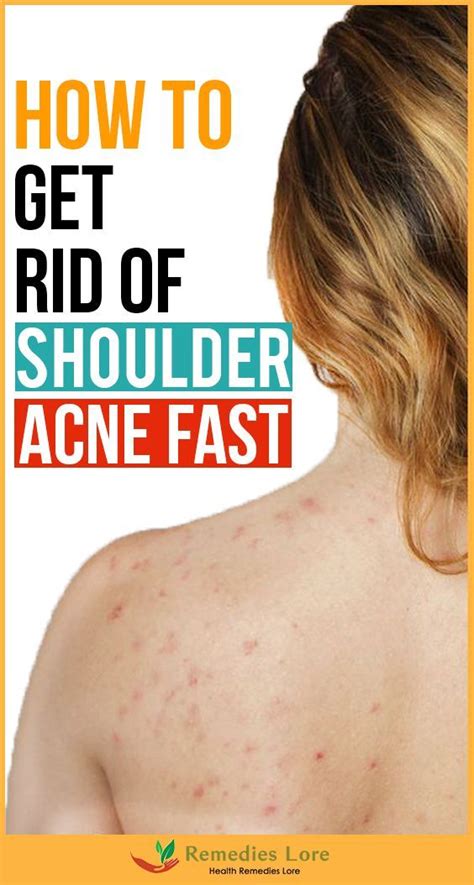 How To Get Rid Of Shoulder Acne Fast Shoulder Acne Chest Acne Fast