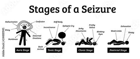 Stages And Phases Of A Seizure Illustrations Depicts The Phases When