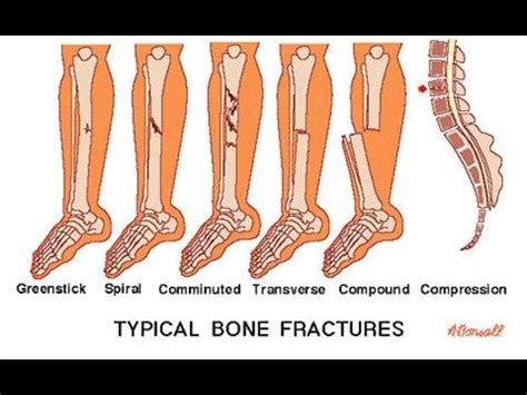 Typical Bone Fractures Nursing Mnemonics Bone Injuries Bone Fracture