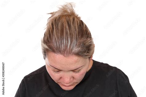 38 Year Old Caucasian Woman With Spot Alopecia Bald Spot On Her Head