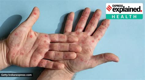 Hand Foot And Mouth Disease Hand Foot Mouth Disease Hfmd Is A