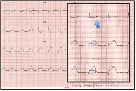 Electrocardiograma Infarto Agudo De Miocardio Generalidades Porn Sex