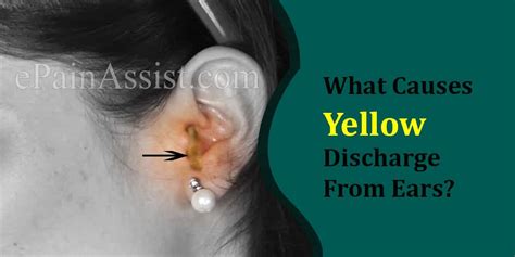 What Causes Yellow Discharge From Ears And What To Do About It