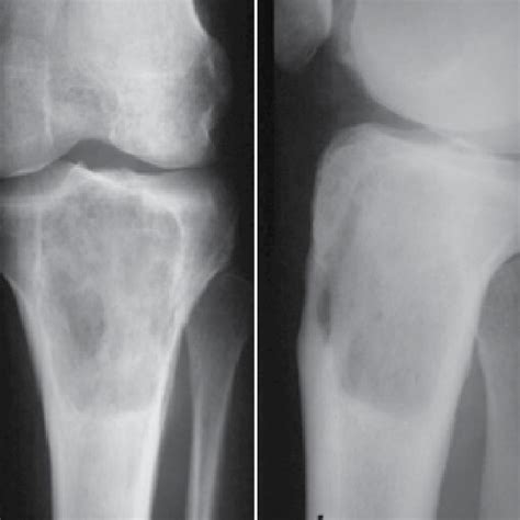 X Ray Image Of A Primary Bone Lymphoma In The Proximal Tibia Prior To