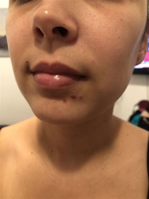 Acne Need Advice Popped Pimples Turned To Scabs I Keep Picking