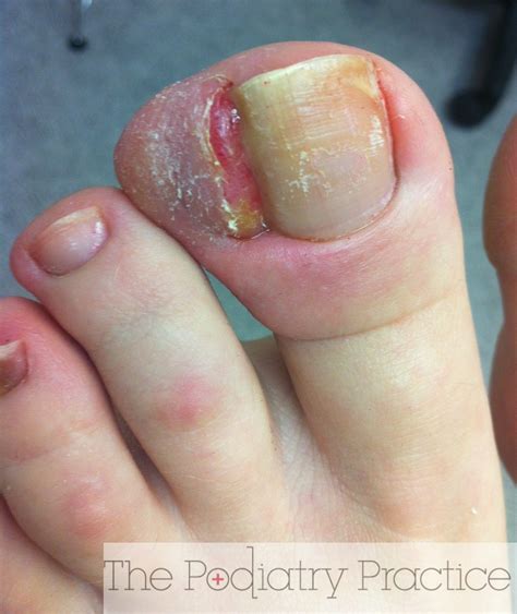 Wow This Is A Severe Ingrown Toenail Podiatrist Brisbane Southside The Podiatry Practice
