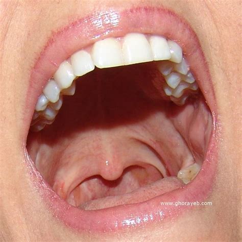 Tonsillectomy Scar Scar Otolaryngology Picture