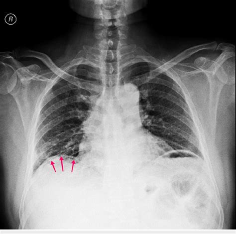 Chest X Ray Showing A Thin Rim Of Air Under The Right Diaphragm Red