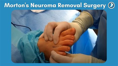 Mortons Neuroma Removal Surgery Youtube