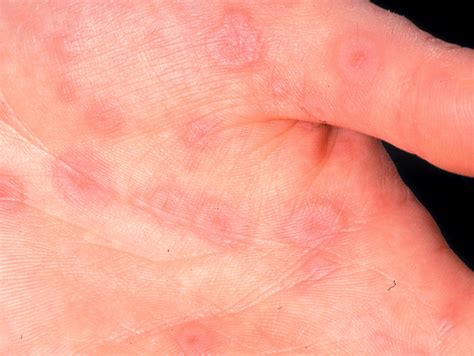 More Common Skin Infections In Children The Bmj