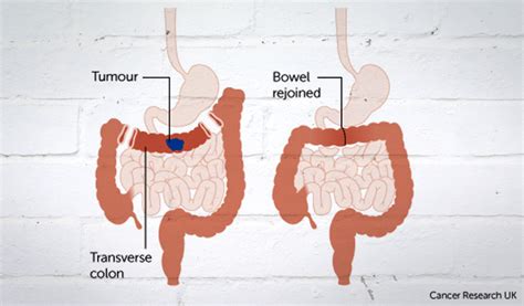 Bowel Cancer Surgery Complications And Recovery