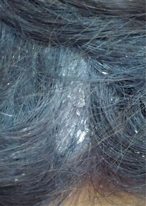 RACGP - An itchy, scaly plaque on the scalp