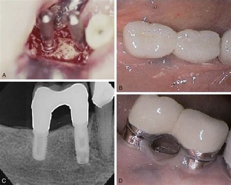 Complications Associated With Immediate Implant Placement Pocket
