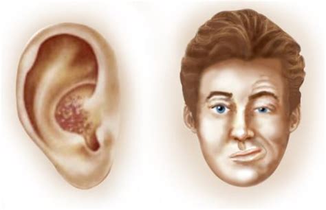 Ramsay Hunt Syndrome Type 2 Alchetron The Free Social Encyclopedia