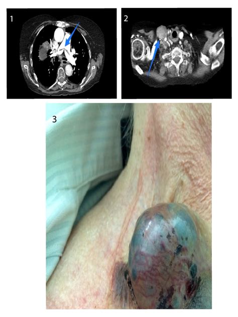 Muscles, blood vessels or nerves in the neck the larynx (voice box) Lymph-node Metastasis in Advanced Papillary Thyroid Cancer
