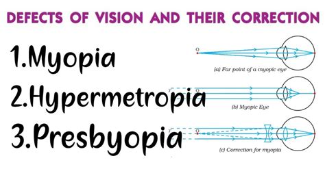 Myopia Hypermetropia Presbyopia Defects In Human Eye And Their