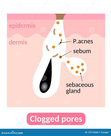 Sebum Plugs Causes Clogged Pores Which Lead To Acne Skin Care Concept