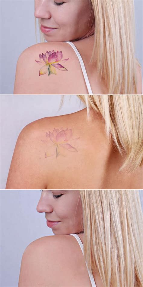 Laser Tattoo Removal Toronto 01 Toronto Facial Plastic Surgery And Laser Centre Dr Torgerson