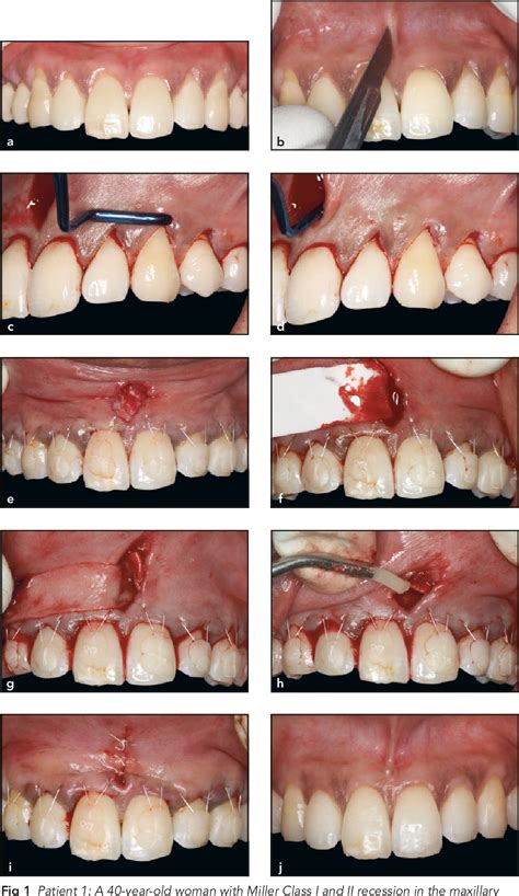 Figure From Management Of Multiple Gingival Recessions With The Vista