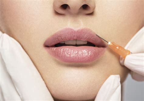O que você precisa saber sobre preenchimento labial