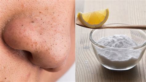 How To Get Rid Of Blackheads On Your Nose Instantly Just 3