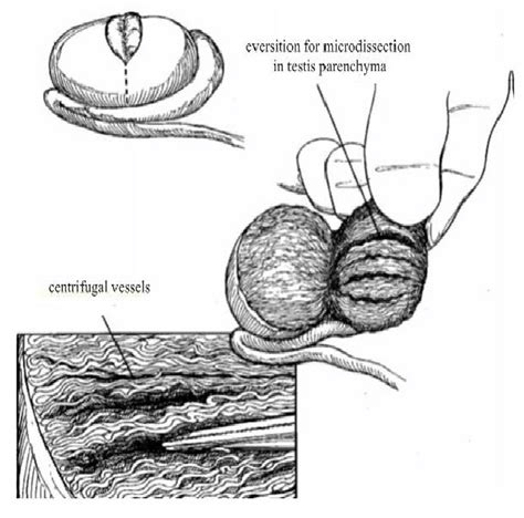 Schematic Drawing Of The Incision In The Micro Tese Operation Showing