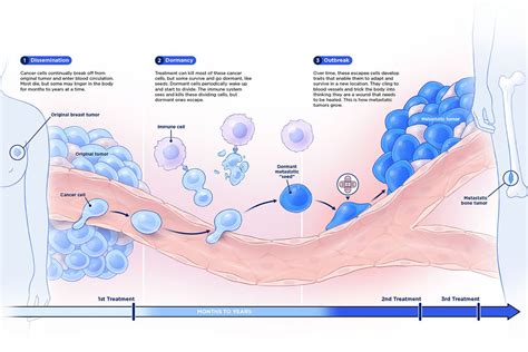 Msk News Metastasis A Roadmap Memorial Sloan Kettering Cancer Center