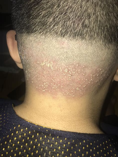 My Brother Got Folliculitis On His Scalp 😳 Rpopping