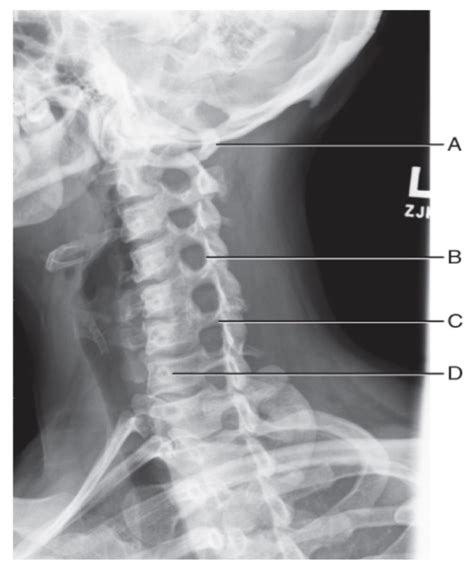 Right Posterior Oblique Cervical Spine Position Diagram Quizlet