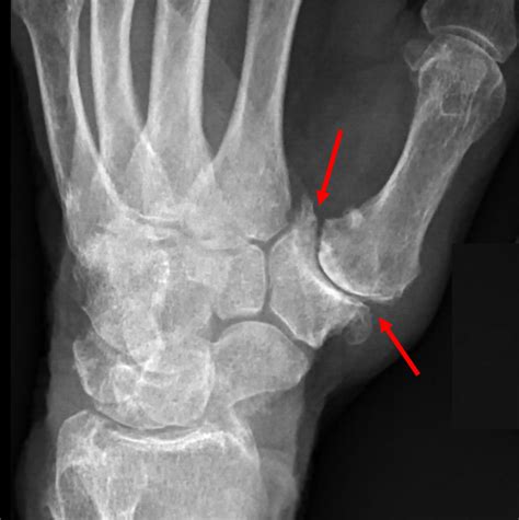 Thumb Arthritis Raleigh Hand Surgery — Joseph J Schreiber Md