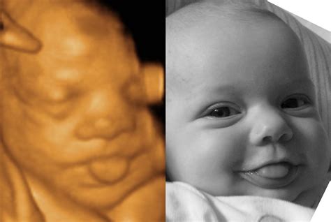 Ultrasounds Difference Between 3d And 4d Ultrasounds
