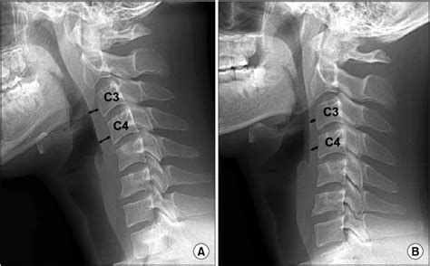 A Initial Lateral Cervical Spine Radiograph Shows Increased Thickness