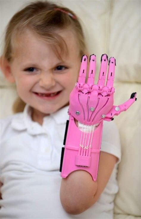 Hayley Fraser Only Five Years Old And Her D Printed Prosthetic Hand