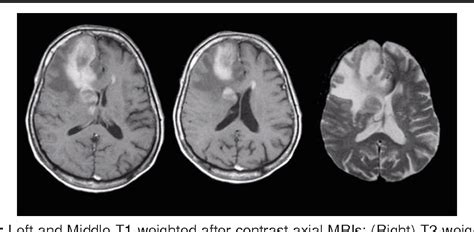 Figure 1 From Mri Findings In Primary Brain Lymphoma In Immunocompetent