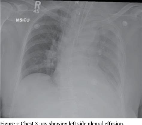 Figure 1 From Gastropleural Fistula Due To Gastric Perforation After