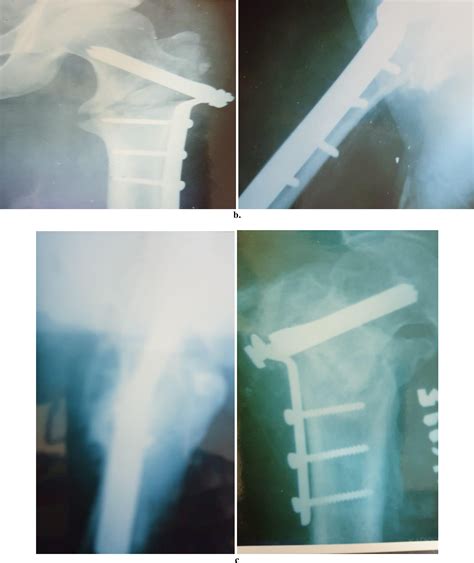 Figure 1 From Sarmiento Osteotomy With Plate And Screw Fixation For