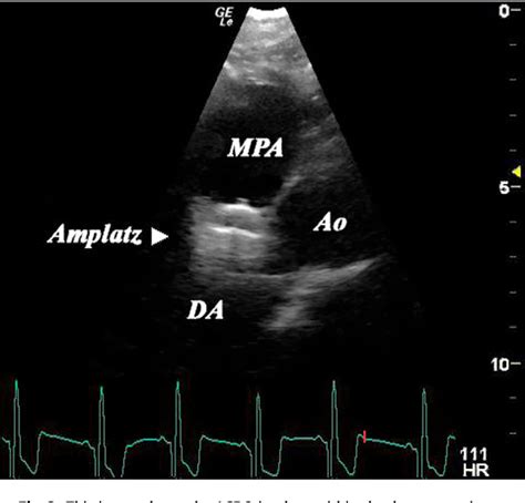 Transthoracic Echocardiographic Guidance Of Patent Ductus Arteriosus