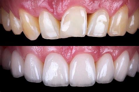 Veneers Before And After South Africa Before And After