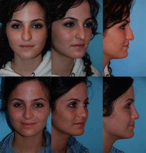 How to contour your nose contouring your nose is to help you create your perfect nose shape and different techniques are used depending on if you want your nose to look thinner, short… Before & After